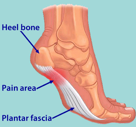 pain under sole of foot